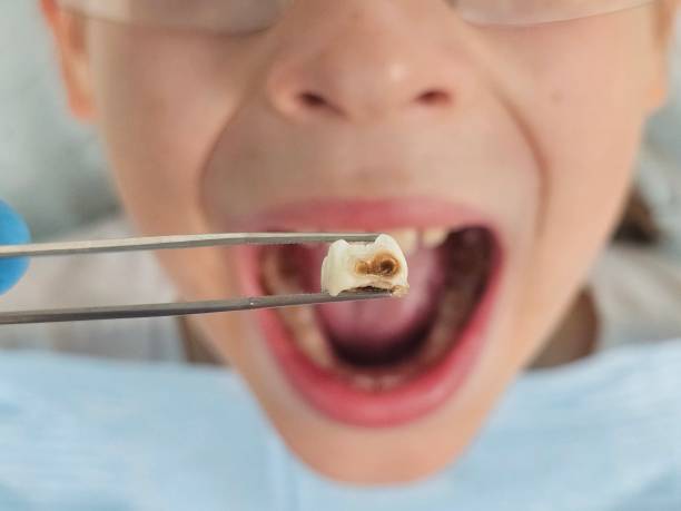 Best Emergency Dental Extractions in Wausau, WI
